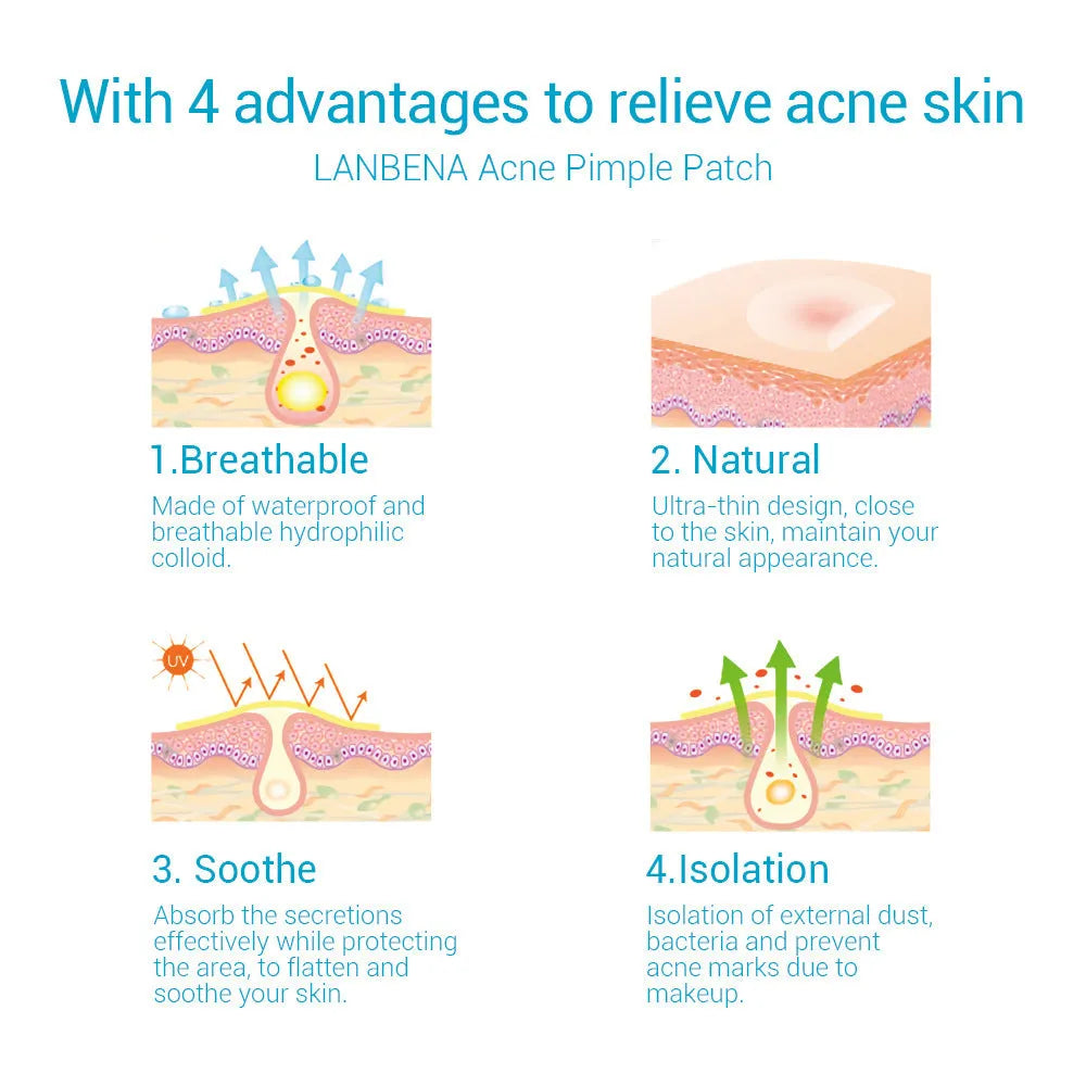 Acne stickers with tea tree oil and Calendula oil for fading blemishes and pimple marks