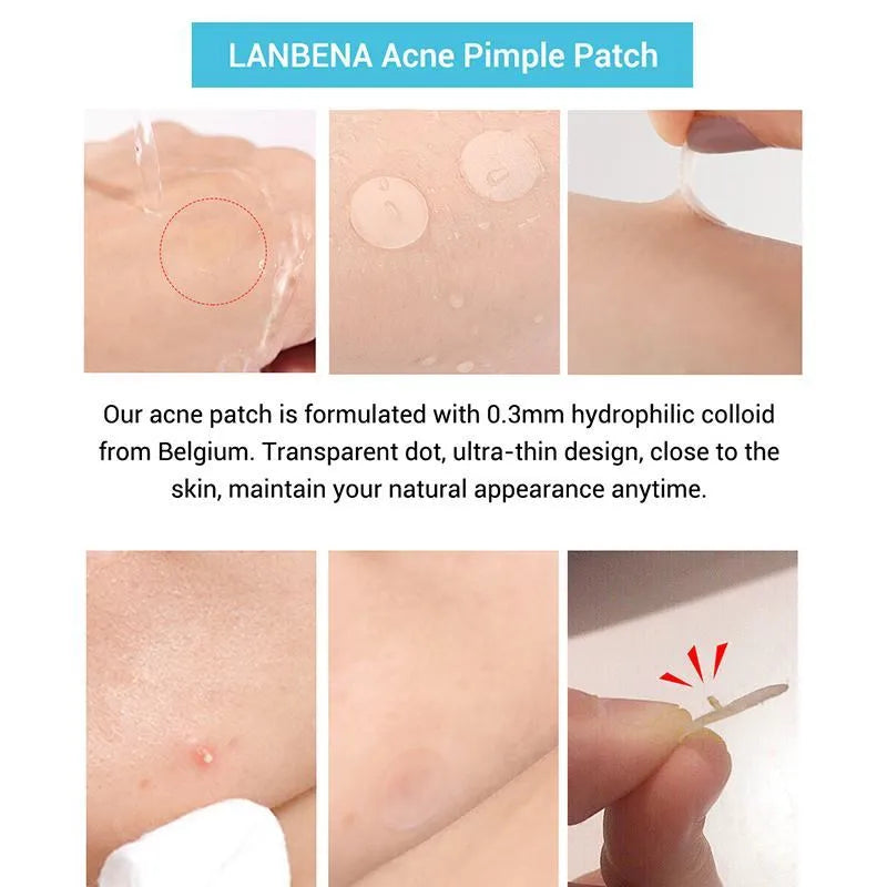 Acne stickers with tea tree oil and Calendula oil for fading blemishes and pimple marks