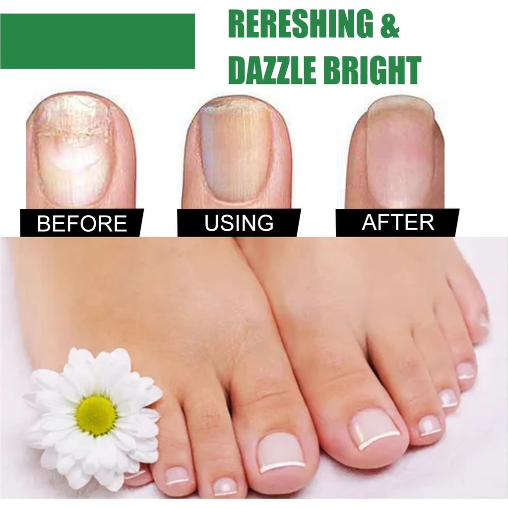 30ml tea tree oil foot nail care solution bottle for thick and brittle nail treatment