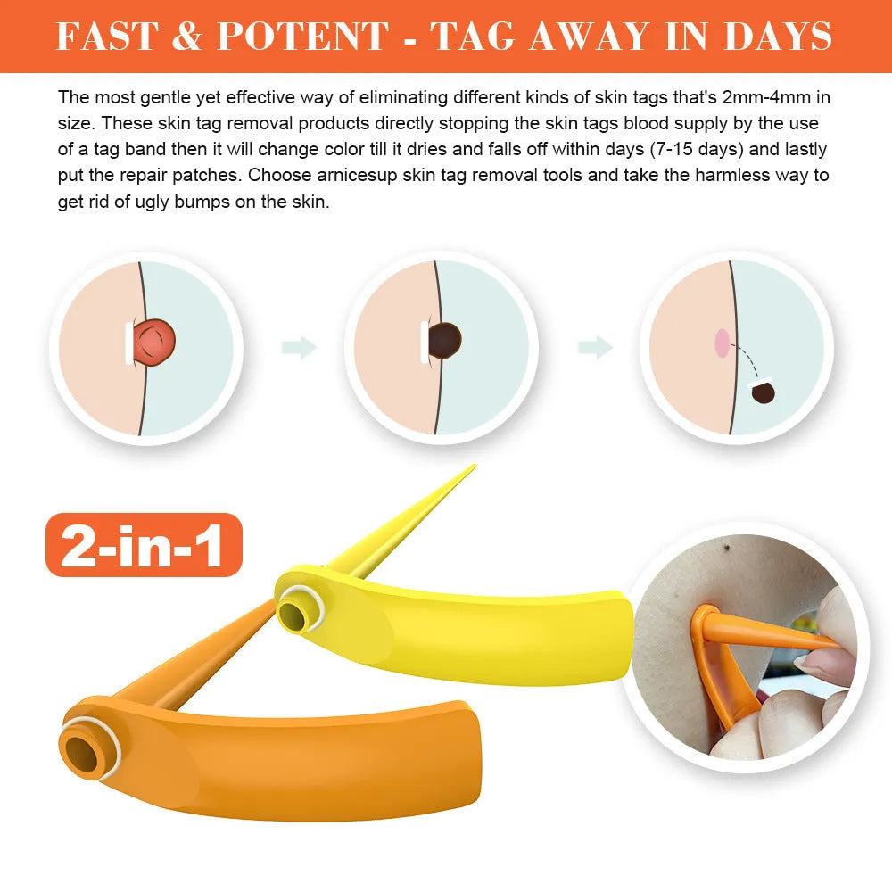 Wart removal tool kit in orange and yellow with two removal devices, cones, rubber rings, alcohol swabs, and repair sticker