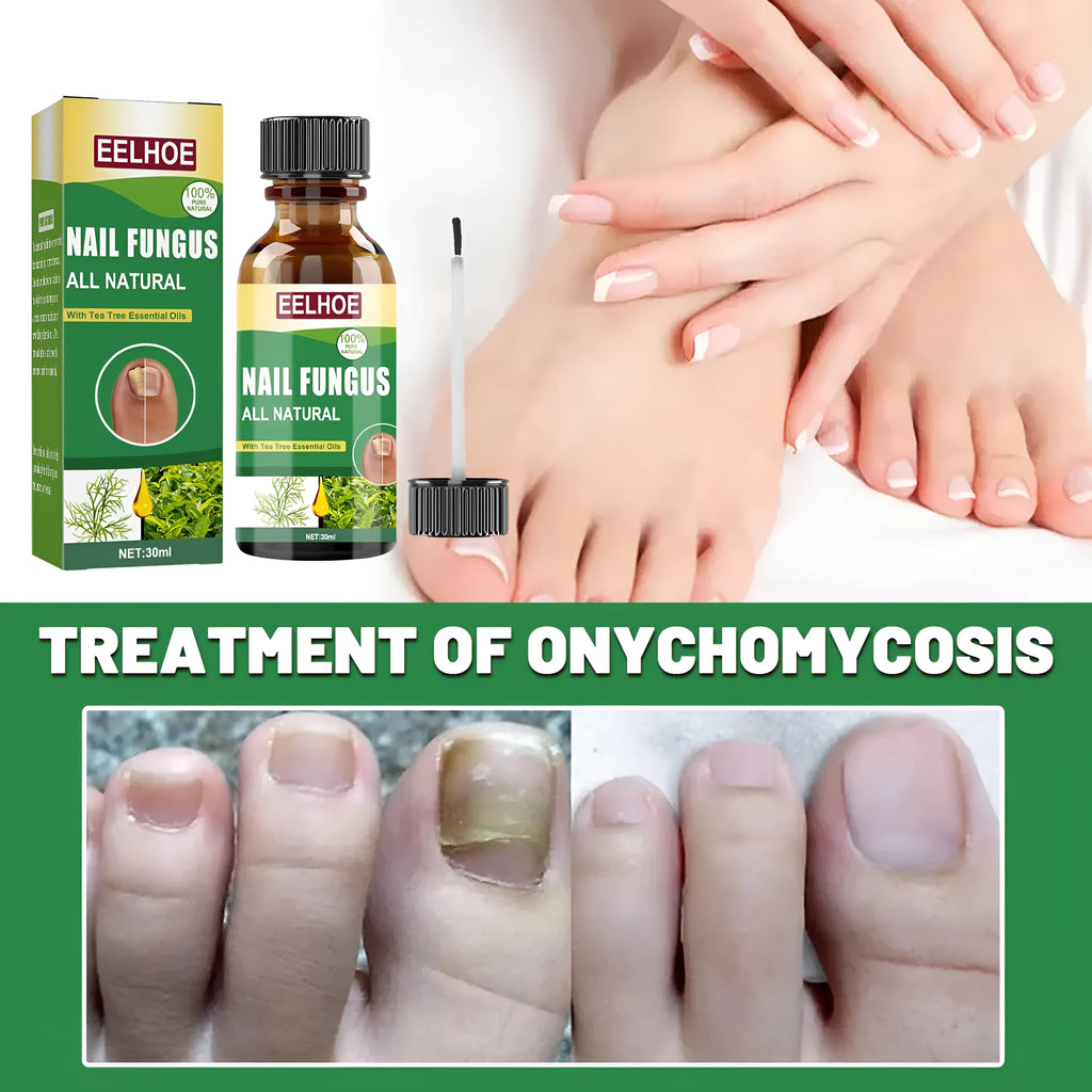 30ml tea tree oil foot nail care solution bottle for thick and brittle nail treatment