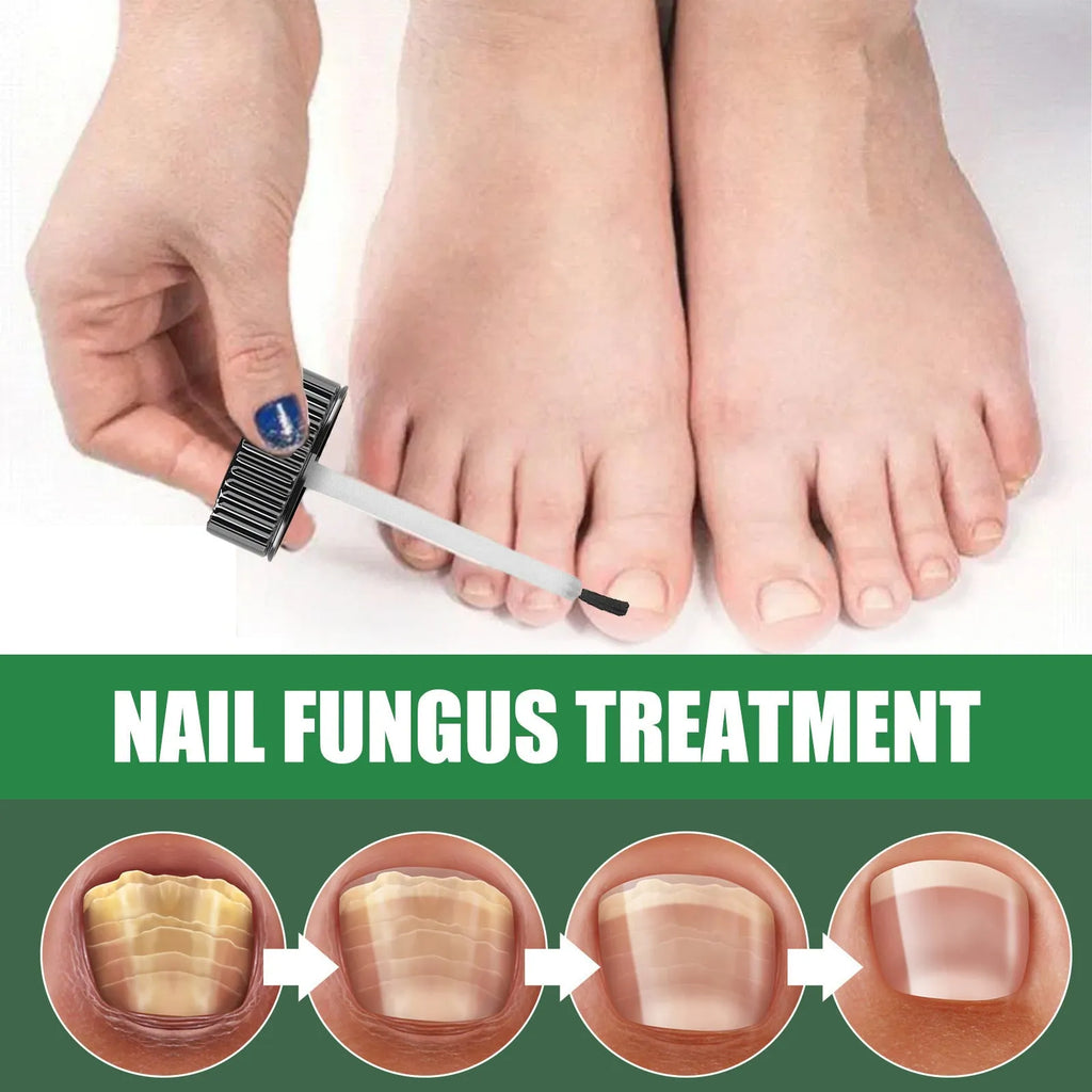 30ml tea tree oil foot nail care solution bottle for thick and brittle nail treatment