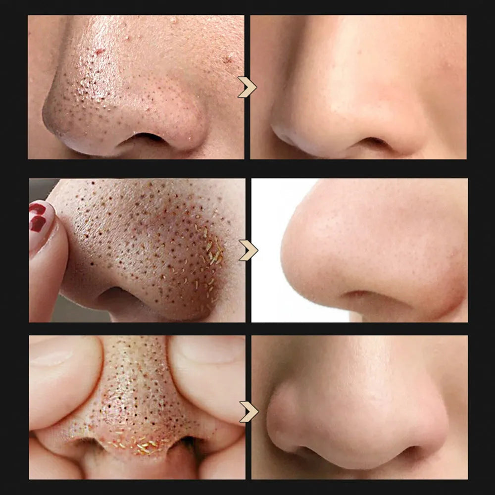 Blackhead Shrinking Combination Kit with two bottles: Blackhead Nasal Liquid and Blackhead Shrinking Serum Series