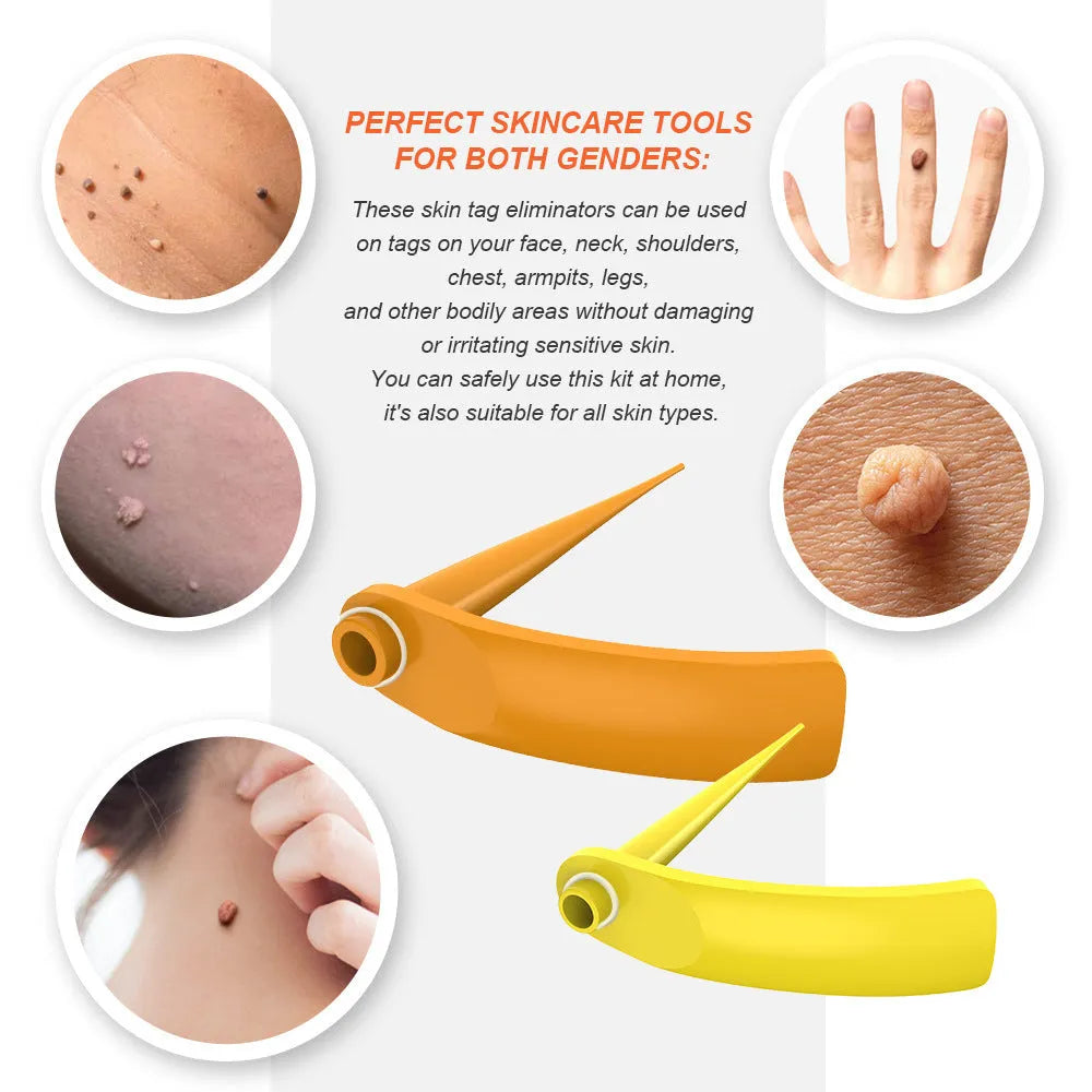 Wart removal tool kit in orange and yellow with two removal devices, cones, rubber rings, alcohol swabs, and repair sticker